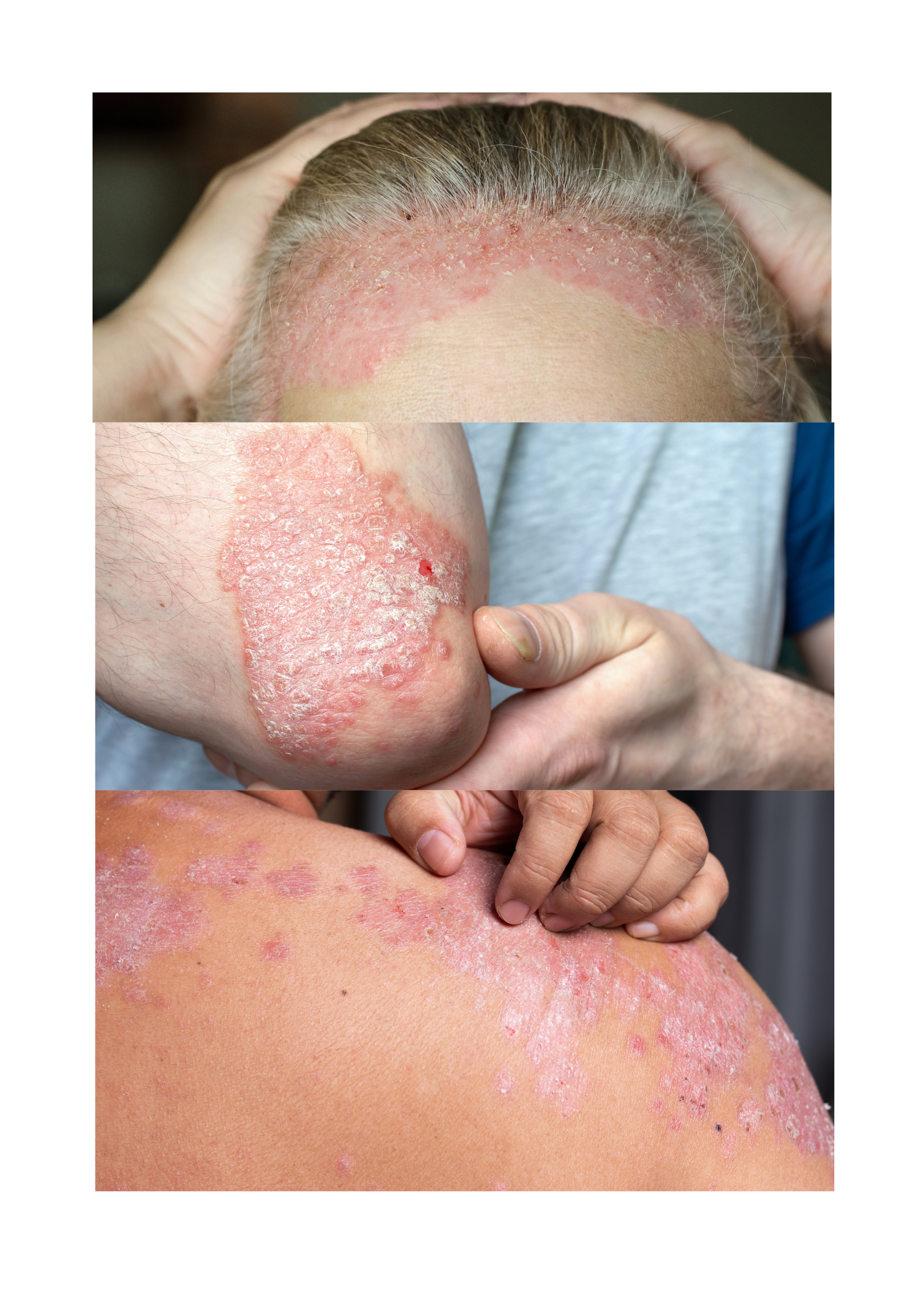 Psoriasis Treatment Near LB Nagar – Holistic and Personalized Care at DR. Shwetha’s Homeopathy