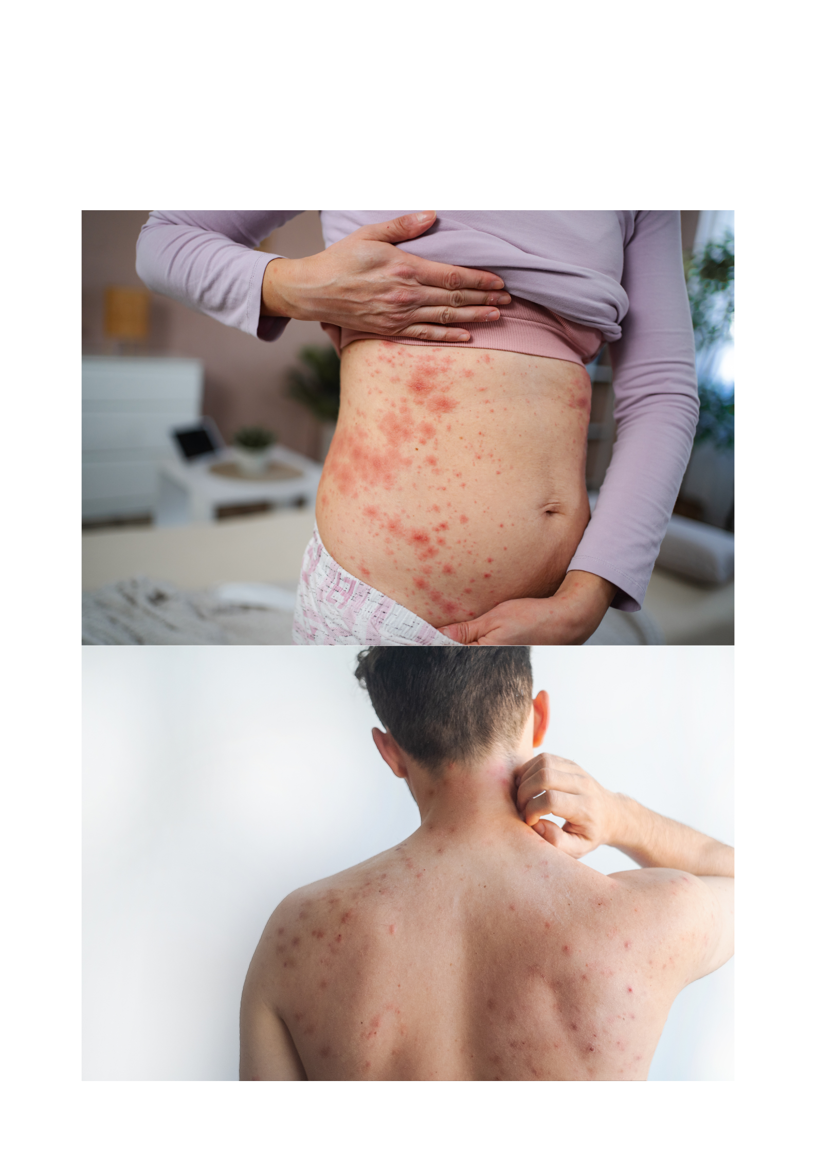 Eczema Treatment in Hayathnagar – Gentle and Holistic Skin Care at DR. Shwetha’s Homeopathy